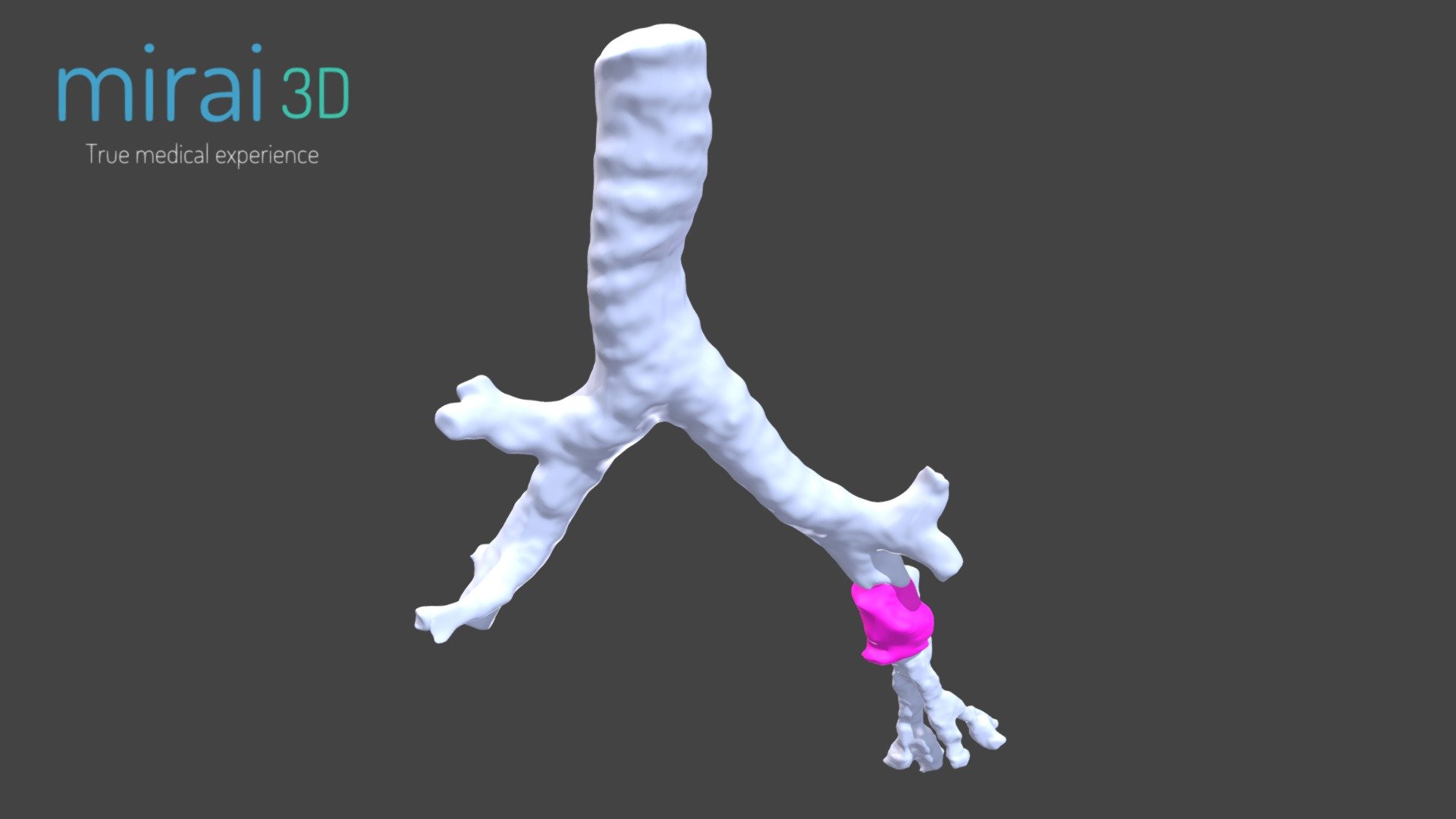 medizinische Modell wp8 - 3d-Modell mirai3d 8db41dd Links bronchial-tumor 3D print model - Mito3D