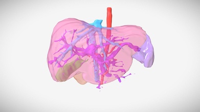 post-op liver anatomy segment 6 7 resected - 3d model tvasurg e4d7739 3d print model - Mito3D