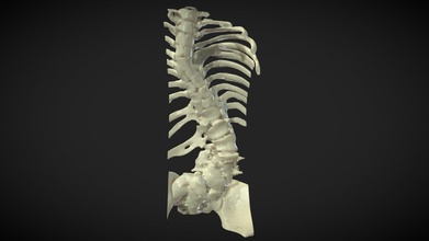 Skoliose Anomalien pre surgical Planung 3d Modell Lincoln wong Lincolnwong 1dcf920 3d print model - Mito3D