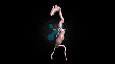böbrek üstü aort anevrizma 010 3d model Humanx 88958f3 3d print model - Mito3D