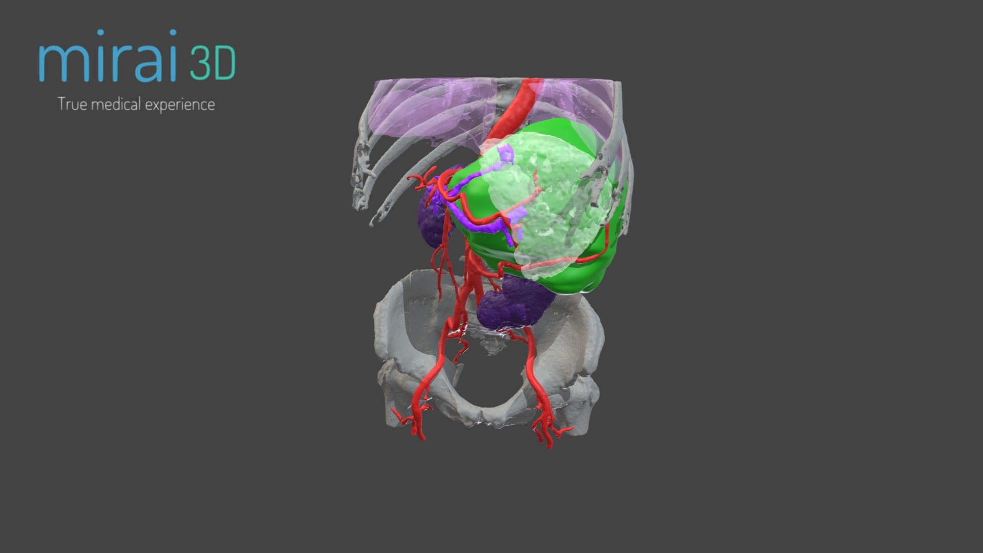 tumor gigante - hpb 3d model mirai3d 4dfc977 3D print model - Mito3D