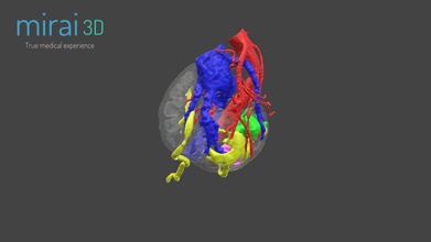 uro-oncology 3d surgical planning - model mirai3d 012be3c 3d print model - Mito3D