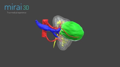 uro-oncology virtual surgical planning - 3d model mirai3d 7ae8035 3d print model - Mito3D