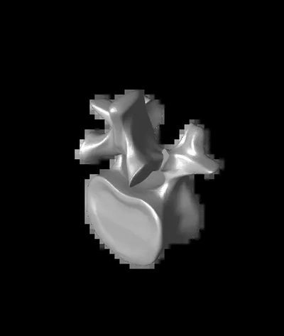 fratura espondilólise 3d by ortopédico ossos on 3d print model - Mito3D