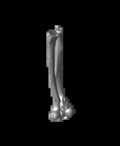 radio cubito eje coronal uniones defectuosas 3d by ortopédico huesos on gracias 3d print model - Mito3D