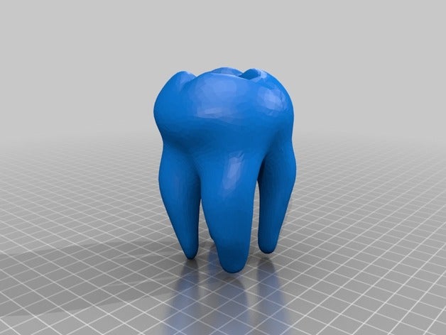 tooth cavities filled people 3D print model - Mito3D