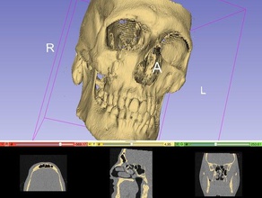 cráneo humano frente a la mitad biología Escaneo 3d hueso mandíbula dientes tomografía 3d print model - Mito3D
