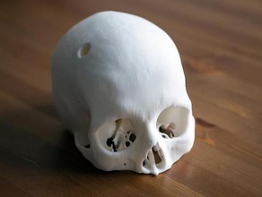 cerebrix crânio humano após a cirurgia biologia ct médico 3d print model - Mito3D