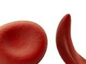 la anemia de células proteínas globina La impresión en 3d ciencia falciformes 3d print model - Mito3D