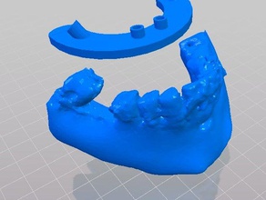 dental-Implantat-Bohrschablone 3d drucken 3d print model - Mito3D