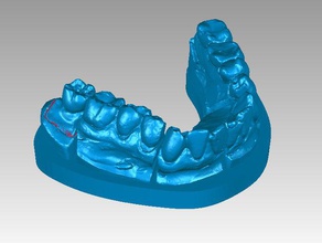 implant de la couronne modèles 3d print model - Mito3D