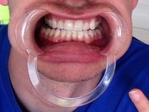 protetor bucal desafio outros bocal de boca 3d print model - Mito3D