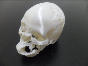 post surgery traumatized skull biology medical orthopedics 3d print model - Mito3D