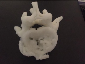 dorsal fratura de vértebras modelos anatomia neurocirurgia coluna vertebral 3d print model - Mito3D