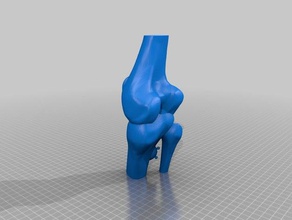 knee-exostose 3d printing 3d print model - Mito3D