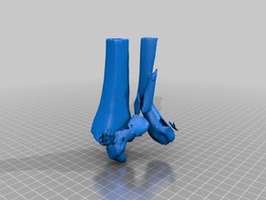 quebrado o tornozelo 3d impressão 3d print model - Mito3D