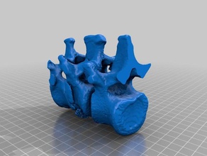 lombare frattura altri ortopedia colonna vertebrale il trauma traumatologia 3d print model - Mito3D