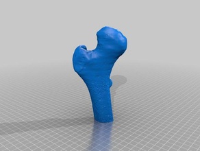 la necrosis avascular de cabeza femoral otros fémur cirugía ortopédica ortopedia traumatología 3d print model - Mito3D
