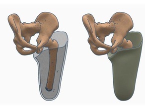 transfémorale au-dessus du genou ischiatiques de confinement emboîture prothèse pack 1 la biologie les prothèses 3d print model - Mito3D