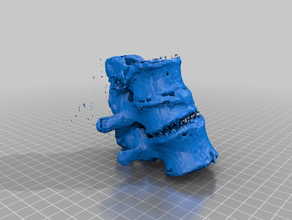 spine fracture 3d printing 3d print model - Mito3D