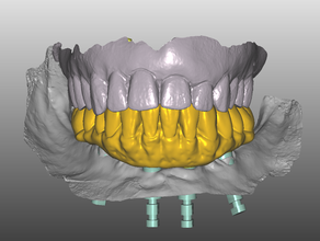 zirkonzahn toronto-Brücke, Zahntechniker arbeiten dent dental dentalmodel Zahnarzt Zahnmedizin Zahnarzt-Stuhl Büro medizinischen Geräten Pädiatrische Studenten-Projekt 3d print model - Mito3D