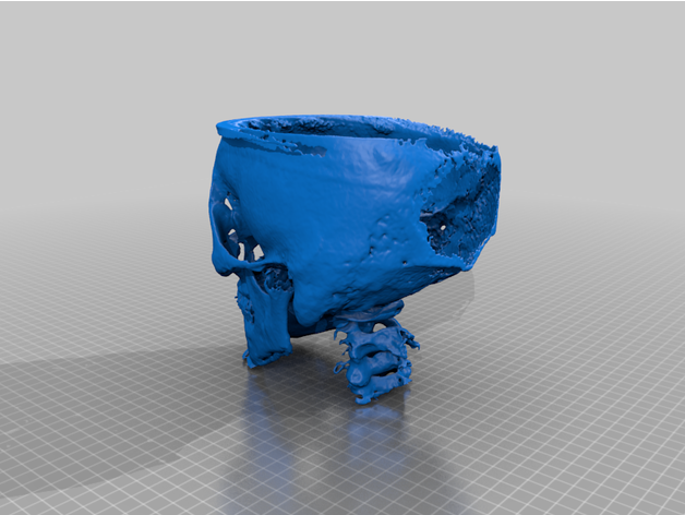 ffs cráneo pre post 3D print model - Mito3D