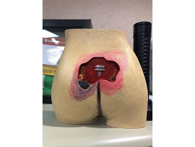 model sacrogluteal wound 3D print model - Mito3D