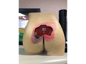 model sacrogluteal wound 3d print model - Mito3D