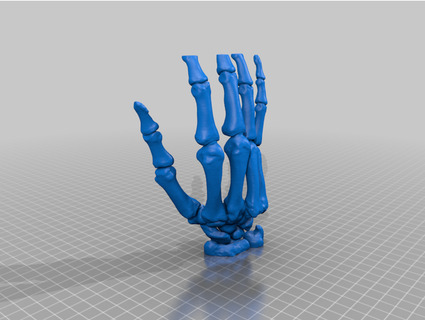 hand bone dislocation 4 5 metacarpal joint drskif 3d print model - Mito3D