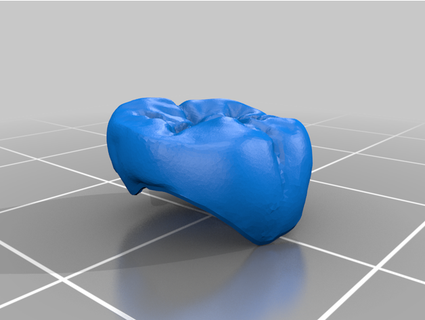 dentale corona ayjoshi 3d print model - Mito3D