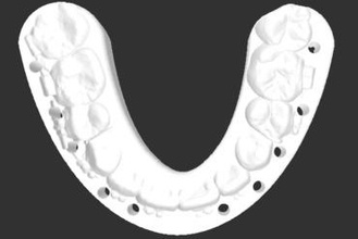 intermediate stent - maxilla first education 3d print model - Mito3D