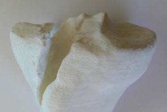 right fractured lateral tibial condyle education fracture tibia medical 3d print model - Mito3D